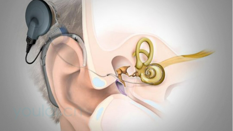 误区六：人工耳蜗可以任何时间植入