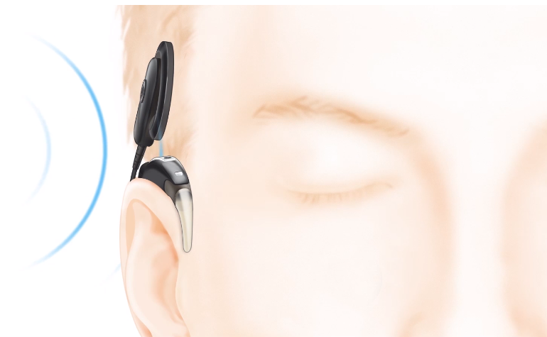 误区五：成人和儿童不适合使用人工耳蜗