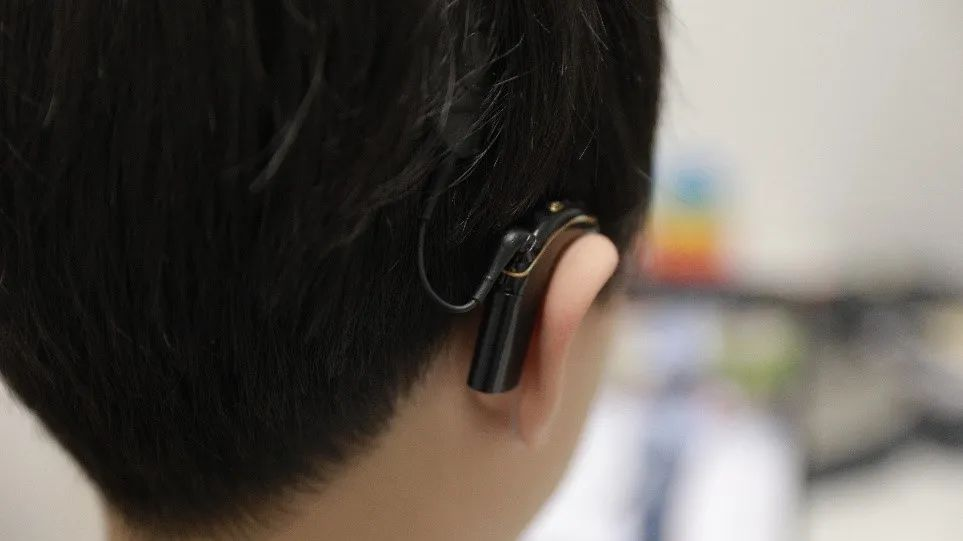 成人植入人工耳蜗_科利耳人工耳蜗品牌