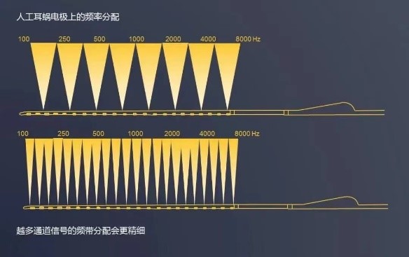 人工耳蜗电极频率 | 植入人工耳蜗帮助提升言语识别率 | 科利耳