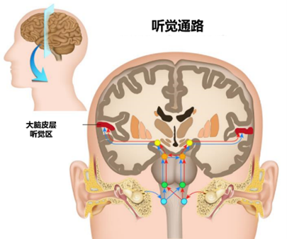 双耳听力损失选择人工耳蜗助听器