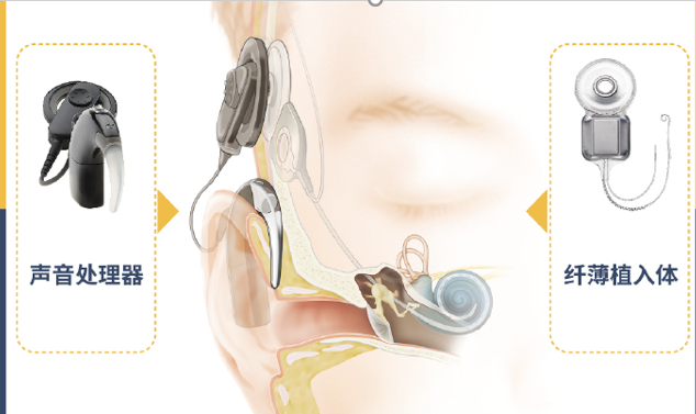 人工耳蜗系统包括植入体和声音处理器两部分